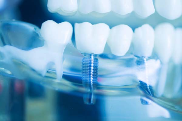 What Is Dental Implant Restoration?