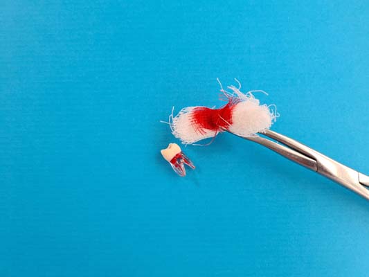 How To Recover From A Wisdom Tooth Extraction